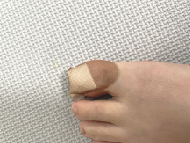 足の指を負傷